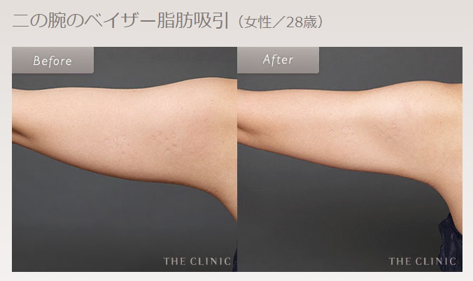 THE CLINICの医療ダイエットビフォーアフター