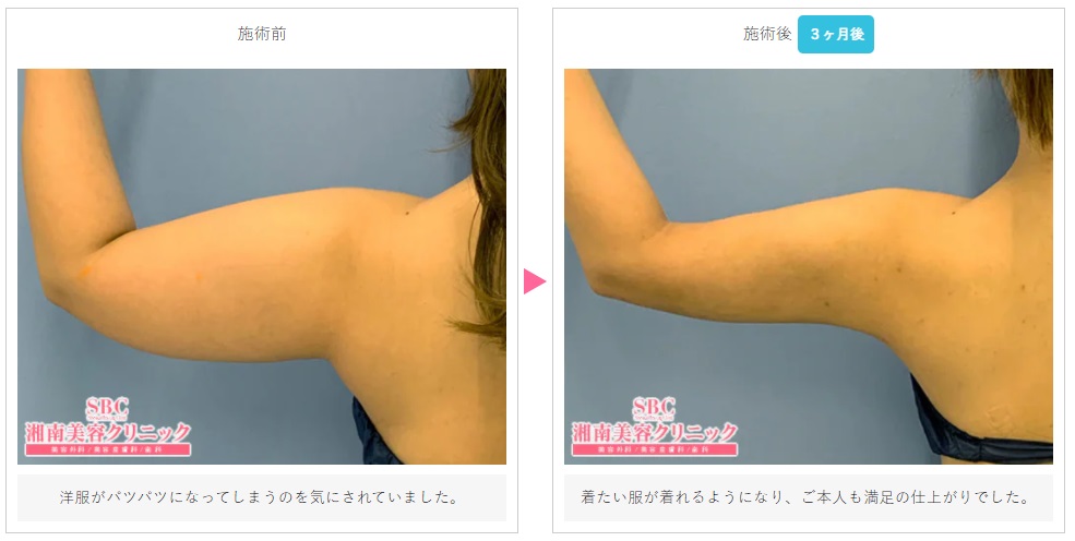 湘南美容クリニックの二の腕の脂肪吸引の症例写真