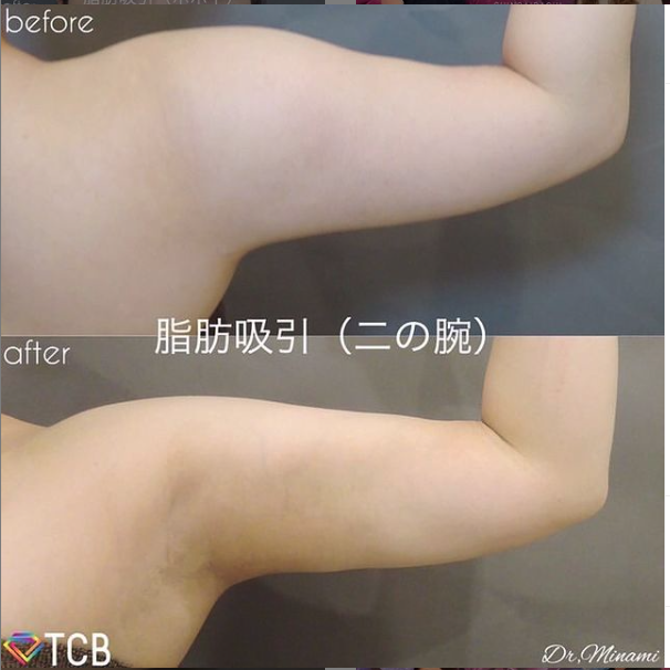 TCBの二の腕の脂肪吸引の症例写真