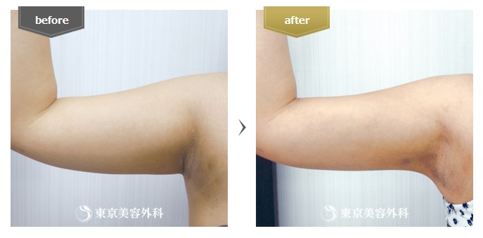 東京美容外科の二の腕の脂肪吸引の症例写真