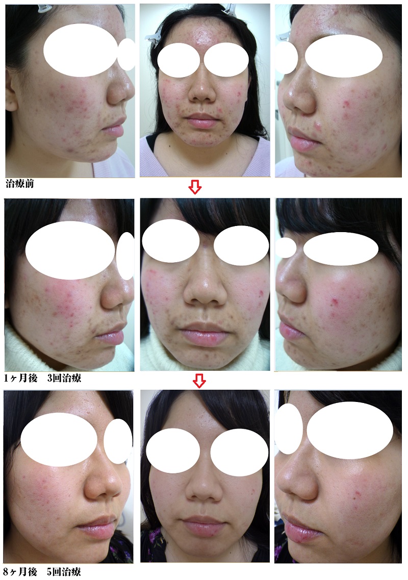 表参道美容皮膚科のケミカルピーリング症例写真
