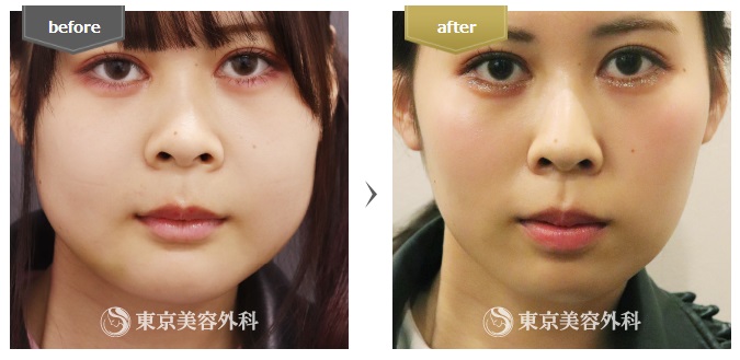 東京美容外科の小顔整形症例写真