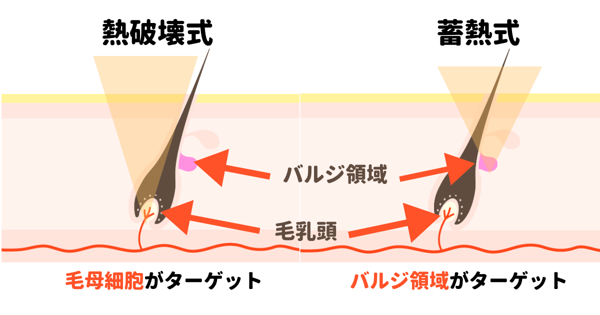 脱毛方式の種類